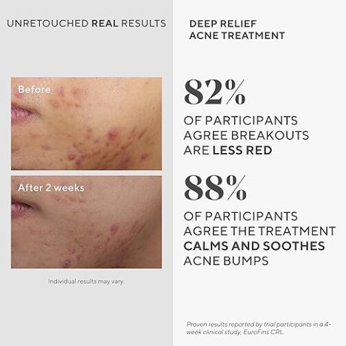 Murad Deep Relief Acne Treatment – 2% Salicylic Acid & Phytosteroid Formula for Deep, Painful Acne Breakouts & Redness - Image 4