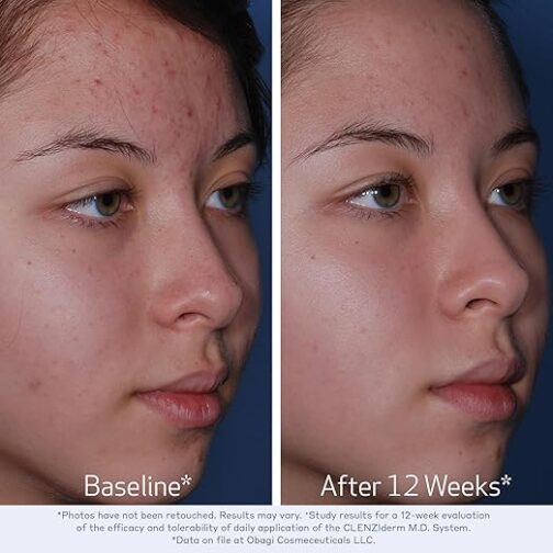 Obagi CLENZIderm M.D. Therapeutic System – Complete 3-Step Acne Treatment with Salicylic Acid & Benzoyl Peroxide - Image 3