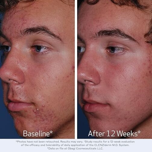 Obagi CLENZIderm M.D. Therapeutic System – Complete 3-Step Acne Treatment with Salicylic Acid & Benzoyl Peroxide - Image 4